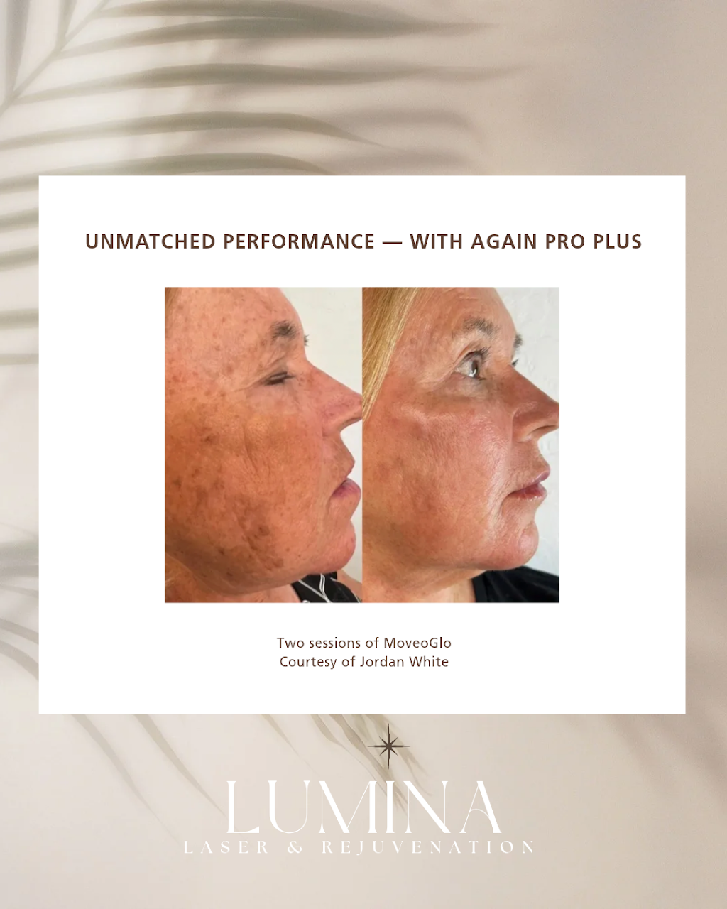 Lumina Laser & Rejuvenation | 40 Bowman St, Richmond NSW 2753, Australia | Phone: 0461 293 621