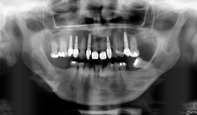 Burleigh Dentistry & Implants | 13/2 Executive Dr, Burleigh Waters QLD 4220, Australia | Phone: (07) 5593 6461