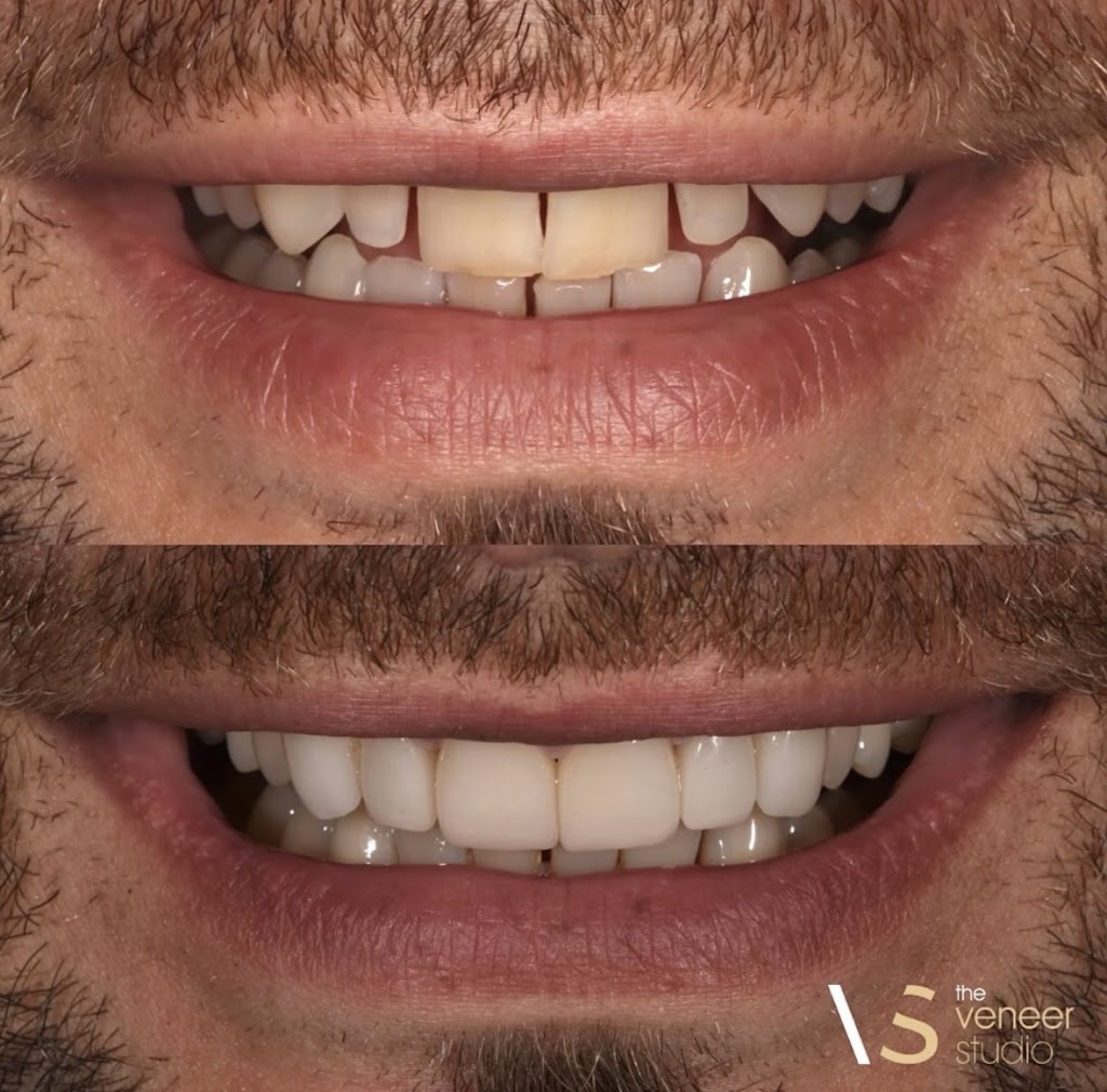 The Veneer Studio | 130 Nepean Hwy, Aspendale VIC 3195, Australia | Phone: 1300 314 473