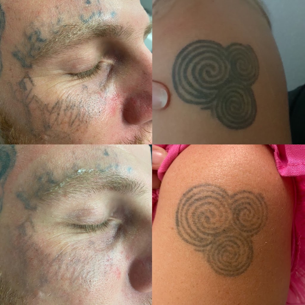 Gold Coast Tattoo Removal |  | 59 Church St, Boonah QLD 4310, Australia | 0402450901 OR +61 402 450 901