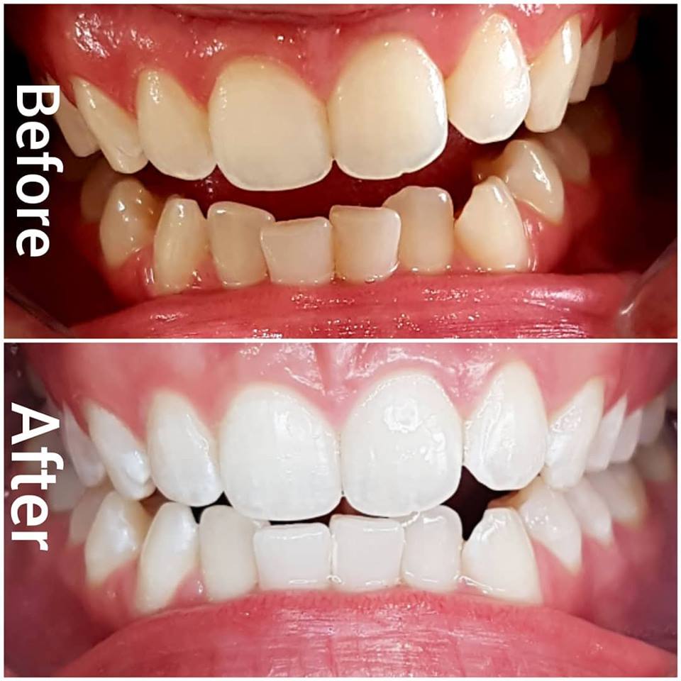 Pearl White Smile | dentist | 6 Fletcher St, Essendon VIC 3040, Australia | 0416102477 OR +61 416 102 477