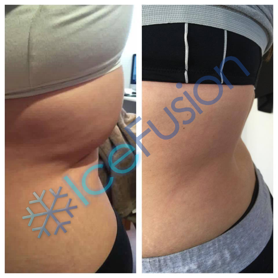 Cryo Body Clinic | 3/8 Rundle St, Kelmscott WA 6111, Australia | Phone: 0438 841 431