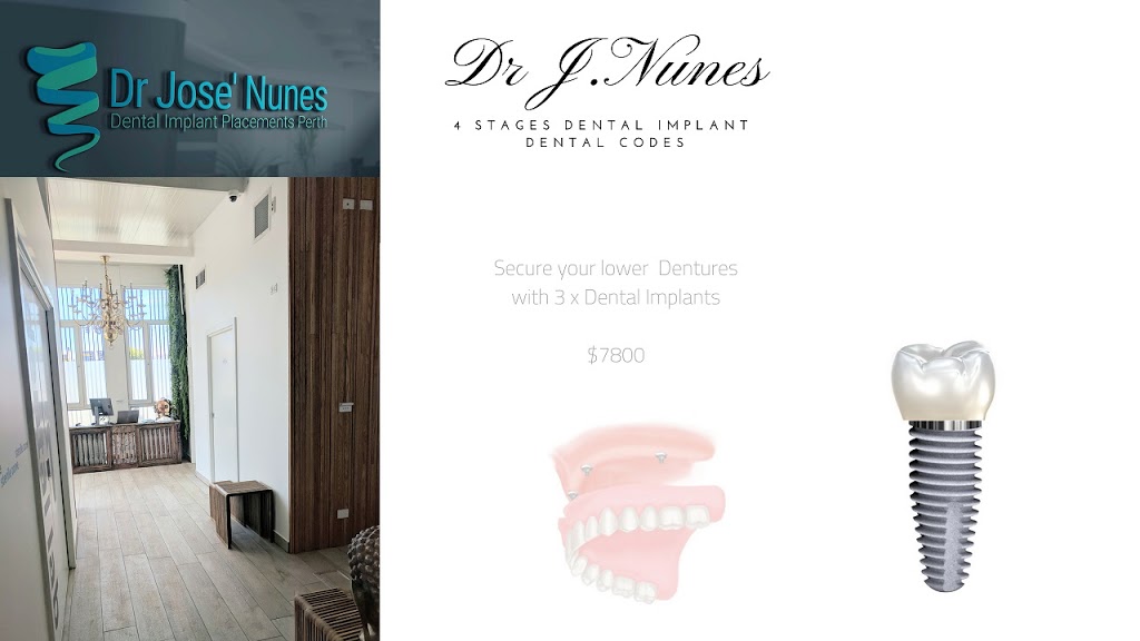 Implant Supported Dentures Perth | 6c Lang street ( Corner Lang street +, Moolyeen Rd, Brentwood WA 6153, Australia | Phone: 0434 998 258