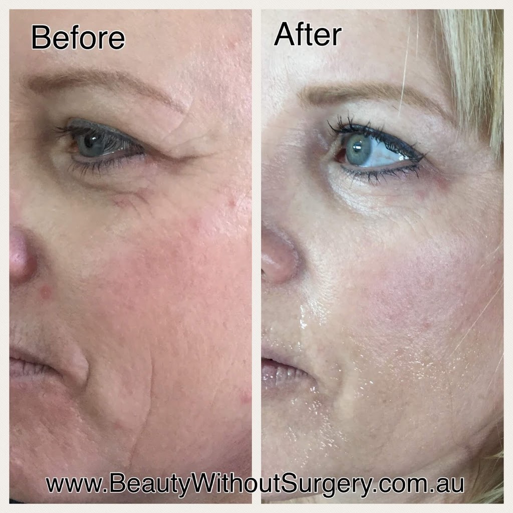 Beauty Without Surgery | 62 The Esplanade, Paradise Point QLD 4216, Australia | Phone: 0404 838 009