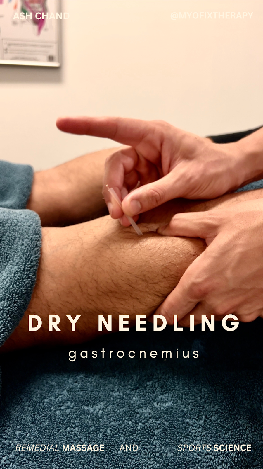 MyoFix Therapy | 1 Monckton Pl, Glenfield NSW 2167, Australia | Phone: 0430 548 866