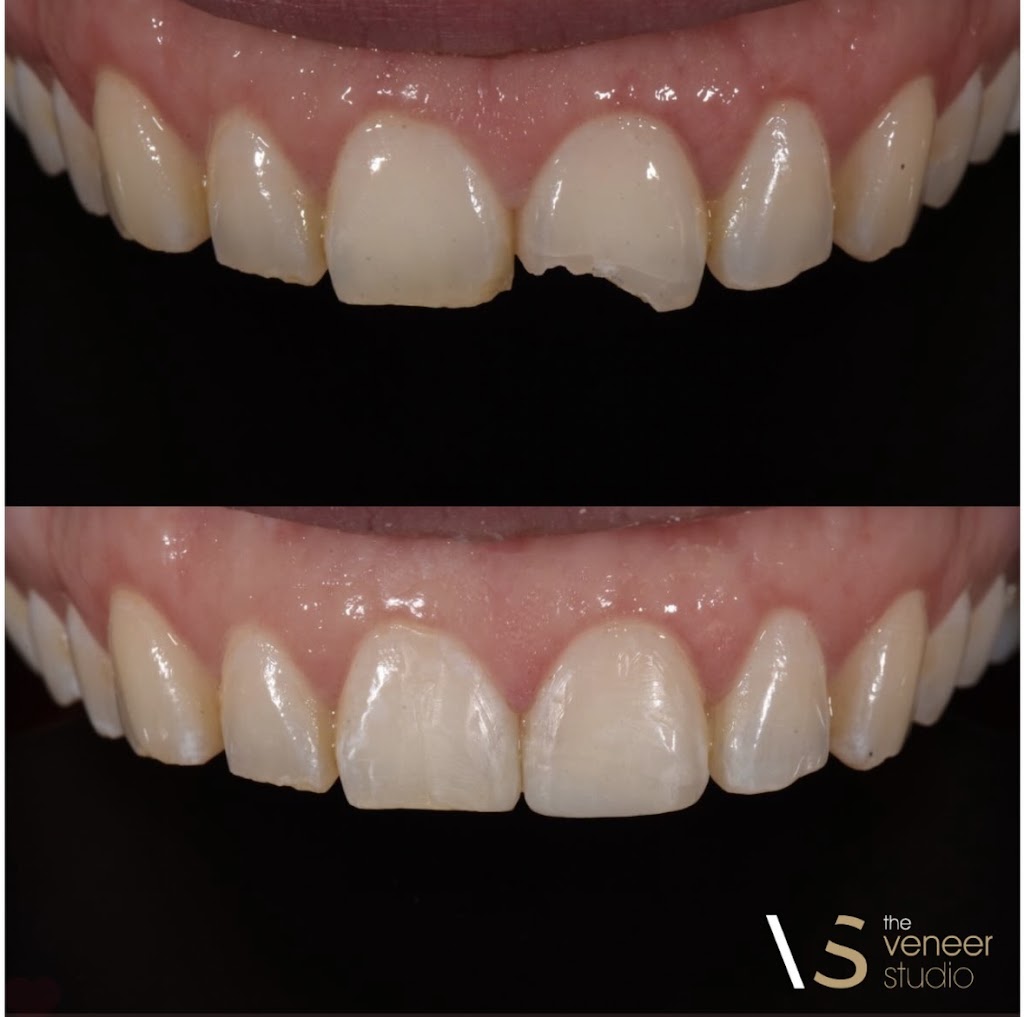The Veneer Studio | 130 Nepean Hwy, Aspendale VIC 3195, Australia | Phone: 1300 314 473