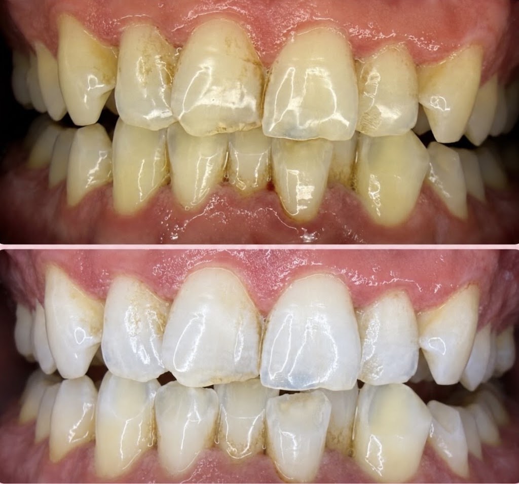 Purely Bright – Teeth Whitening & Brazilian Specialist | 108 Tanner St, Breakwater VIC 3219, Australia | Phone: 0432 037 011