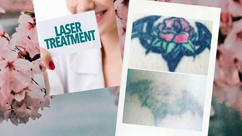 Tattoo removal lismore and beauty services | beauty salon | Fisher streer, Lismore NSW 2480, Australia | 0423240976 OR +61 423 240 976