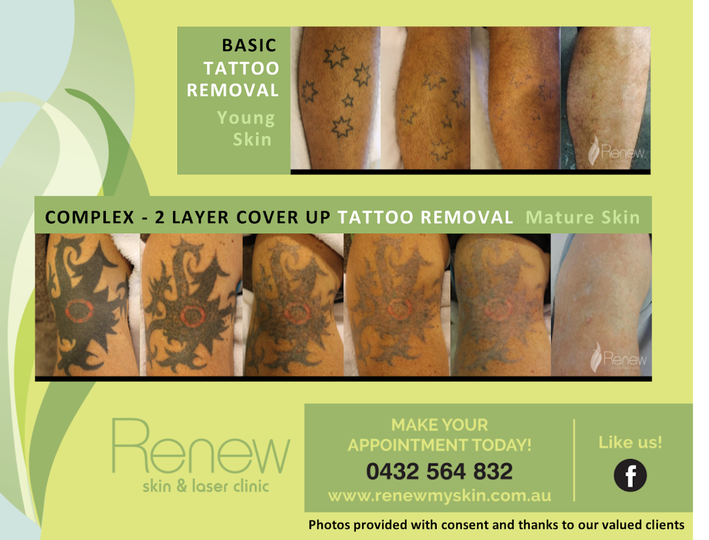 Renew Skin & Laser Clinic | 480 Orara Way, Coramba NSW 2450, Australia | Phone: 0432 564 832 Renew Skin & Laser Clinic | 480 Orara Way, Coramba NSW 2450, Australia | Phone: 0432 564 832