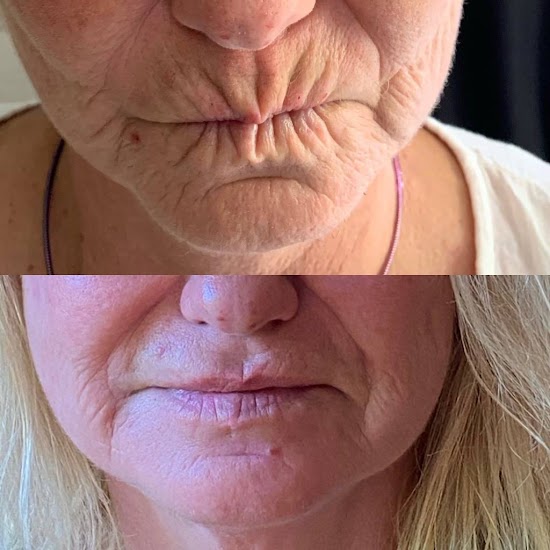 Replenish Co - Anti-Wrinkle Clinic Bathurst | 240 William St, Bathurst NSW 2795, Australia | Phone: 0458 706 785