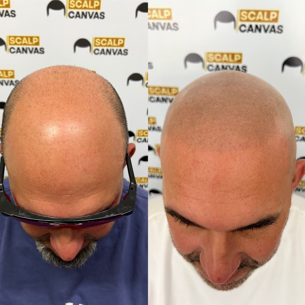 Scalp Canvas - Scalp Micropigmentation Sydney | 1 Inverness Cct, Cecil Hills NSW 2171, Australia | Phone: 0414 400 454