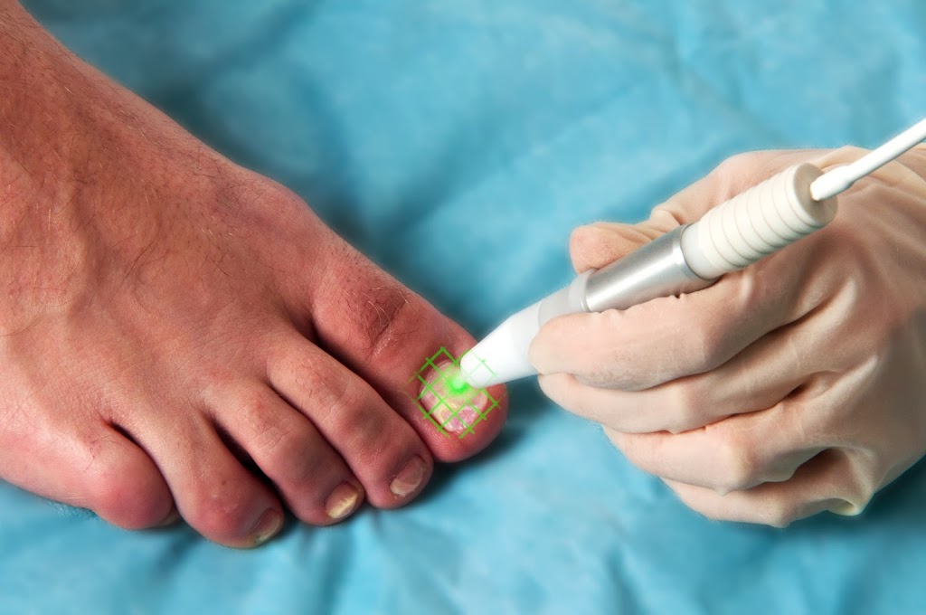 Fungal Nail Laser - Patterson Allied Health | health | Thompson Rd, Melbourne VIC 3197, Australia | 0397761600 OR +61 3 9776 1600