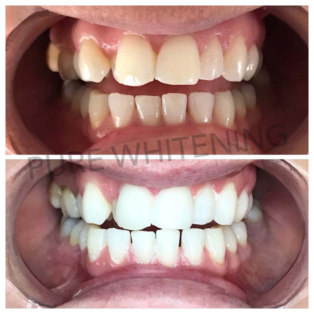 Pure Whitening | dentist | Kendale Way, Meadow Springs WA 6210, Australia | 0481200486 OR +61 481 200 486