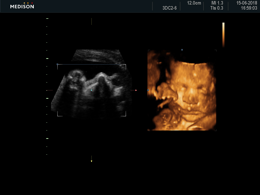 Beautiful Beginnings Maternity 3D/4D Ultrasounds & Photography | 183 Northcott Dr, Adamstown Heights NSW 2289, Australia | Phone: 0439 461 479