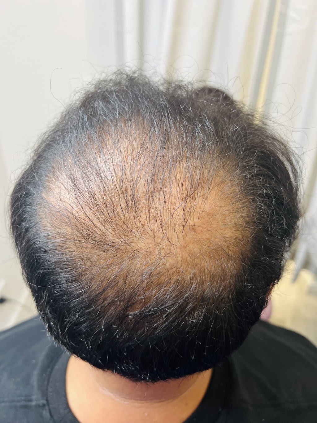 Scalp It SMP Hair Clinic | 11 - 13 Main St, Mount Annan NSW 2567, Australia | Phone: 0405 222 339
