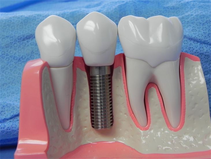 Benowa Mansions Implant & Periodontal Practice - Dr.Latcham Neil | dentist | 3/183 Ashmore Rd, Benowa QLD 4217, Australia | 0755971811 OR +61 7 5597 1811