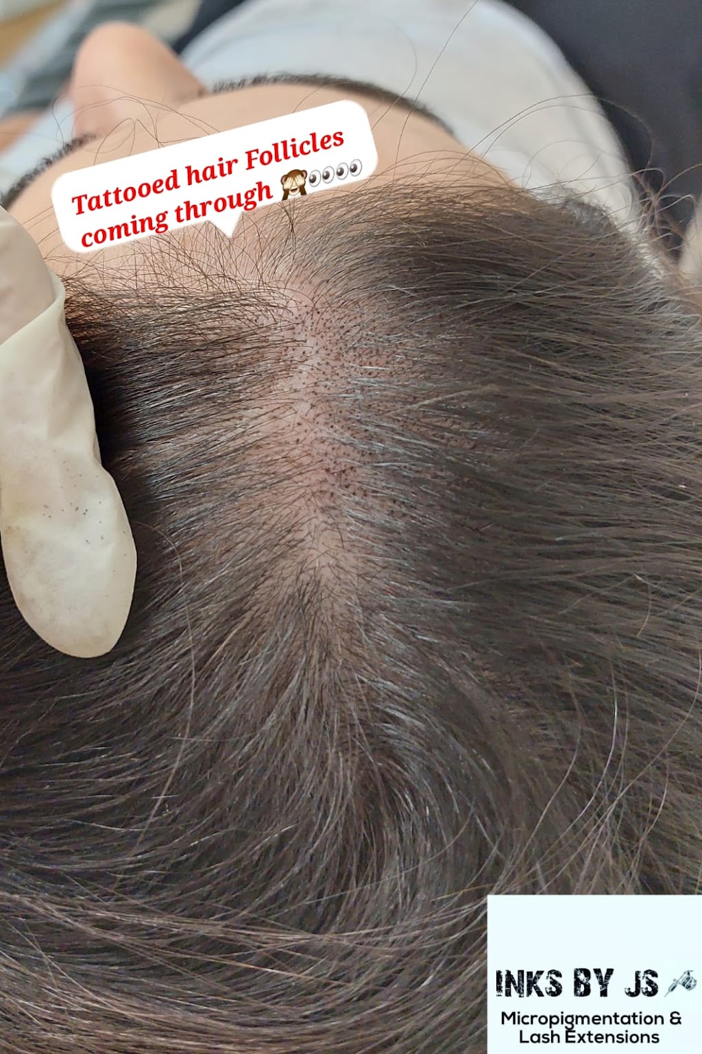 Scalp Micropigmentation SMP Melbourne Inks by JS | hair care | Sayers Rd, Tarneit VIC 3029, Australia | 0421844551 OR +61 421 844 551