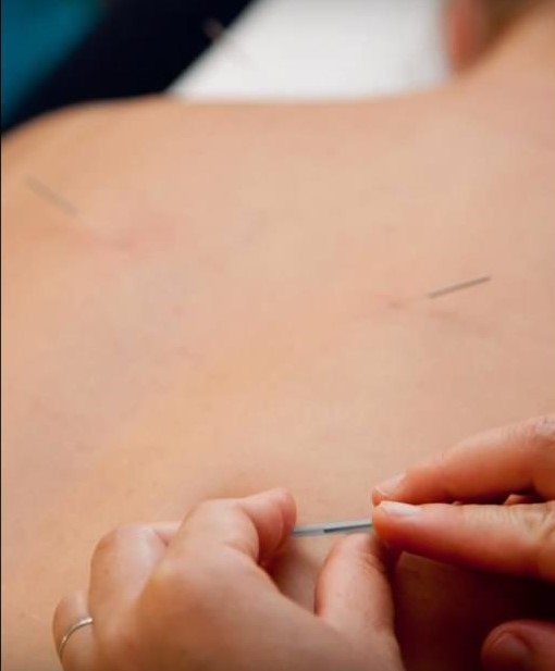 Hui Acupuncture and Holistic Medicine - Moxibustion, Cupping, Ac | store | 19 Allwood St, Indooroopilly QLD 4068, Australia | 0414801287 OR +61 414 801 287