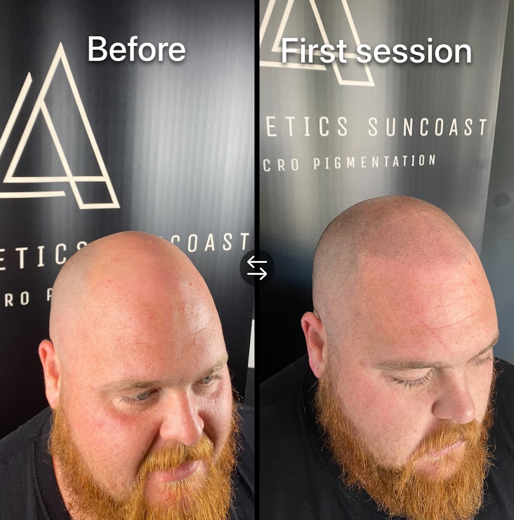 Smp Aesthetics Suncoast | 42 Ngungun Cr, Glass House Mountains QLD 4518, Australia | Phone: 0434 320 318