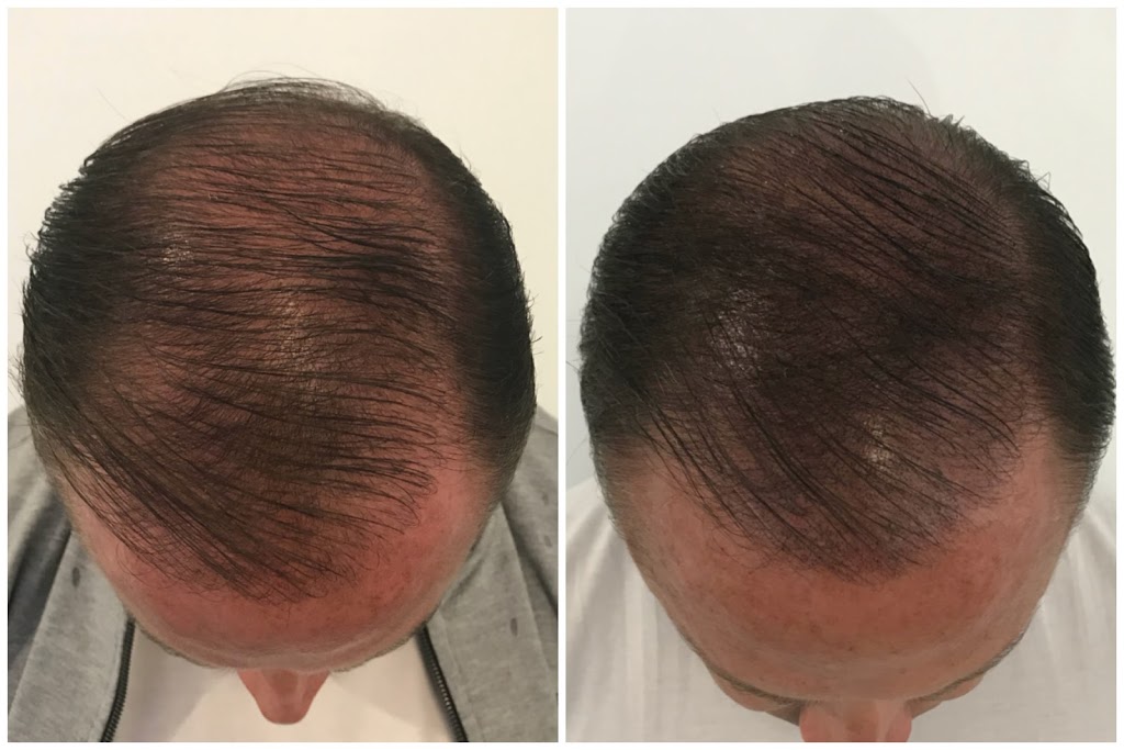 SMP Gold Coast, Scalp Micropigmentation Queensland | hair care | 10/38 Thomas, Chevron Island QLD 4217, Australia | 0755269255 OR +61 7 5526 9255