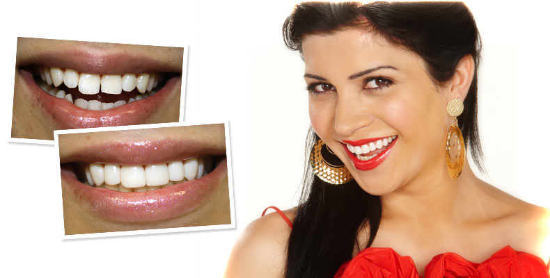 Glamsmile - Dr Parisa Javady | dentist | 20/22 Underwood St, Corrimal NSW 2518, Australia | 1300452676 OR +61 1300 452 676