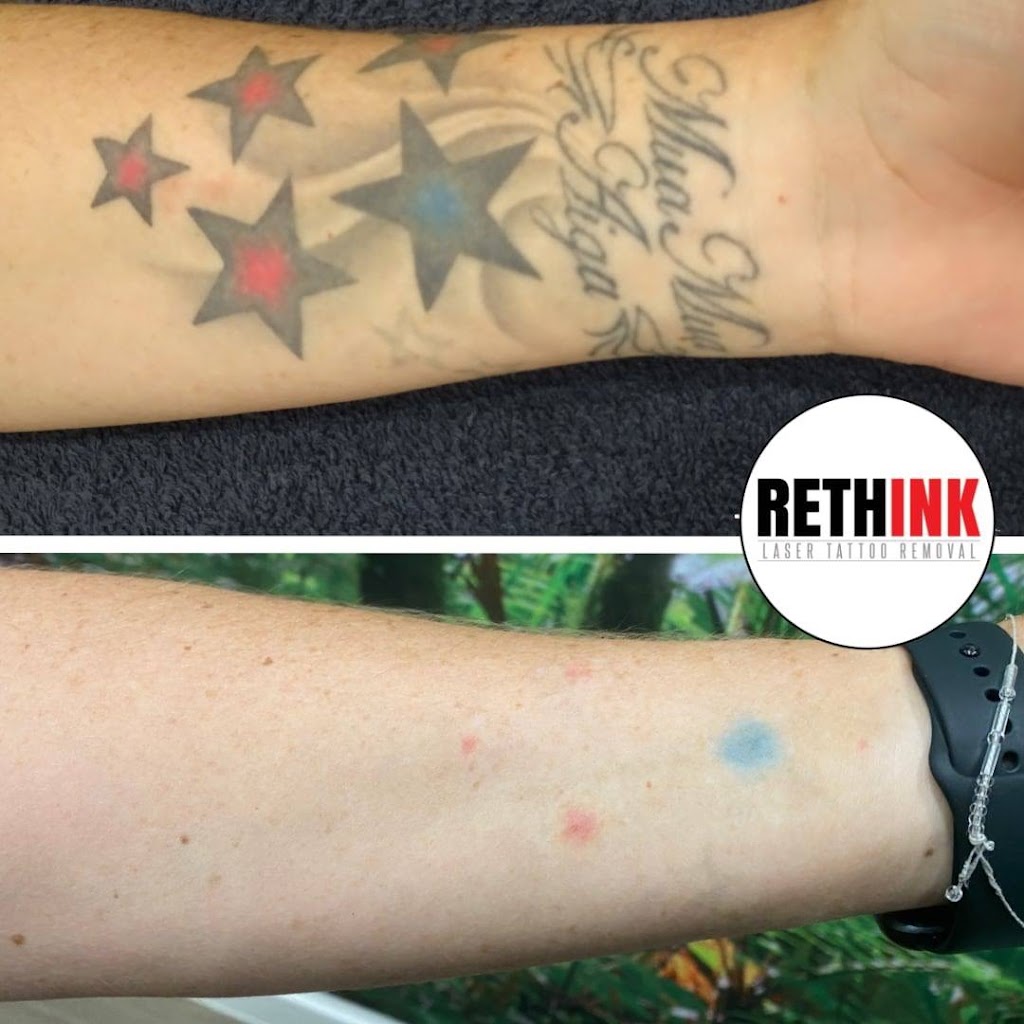 Rethink Laser Tattoo Removal | 20/137 Scottsdale Dr, Robina QLD 4226, Australia | Phone: (07) 5636 1111